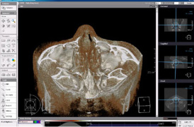 歯科用CT